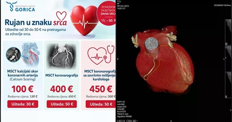 Povodom Svjetskog dana srca posebne cijene MSCT pregleda u Medicinskom centru Gorica